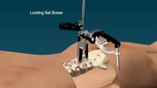 AnyPlus MIS Percutaneous Pedicle Screw System [upl. by Wernher]