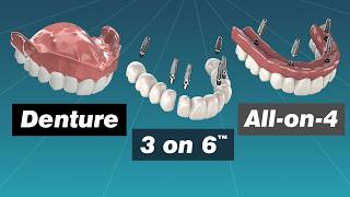 Alternative to Dentures Comparing Dentures Overdentures Allon4 and 3 on 6™ [upl. by Eerized]