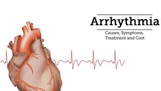 Supraventricular tachycardia SVT [upl. by Asilaj]