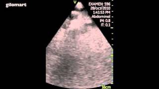 VSCAN Biliary dilatation Pocket Ultrasound Dilatación vía biliar Ecografía de bolsillo [upl. by Edaw]