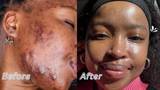 MY ACNE JOURNEYHow I cleared my hormonal amp cystic acne  South African YouTuber [upl. by Tanney726]