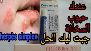 علاج فعال لحبوب السخانة حول الفم والأنف او مايسمى herpes [upl. by Reena]