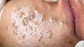 Big Cystic Acne Blackheads Extraction Blackheads amp Milia Whiteheads Removal Pimple Popping  235 [upl. by Annasus]