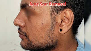 Acne Scar Removal treatment in Delhi  Fractional CO2 Laser along with Face CGF  PRP Delhi shorts [upl. by Kendell]