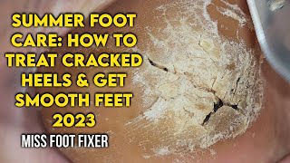 Summer Foot Care How to Treat Cracked Heels and Get Smooth Feet by foot Specialist Miss foot Fixer [upl. by Yrdua235]