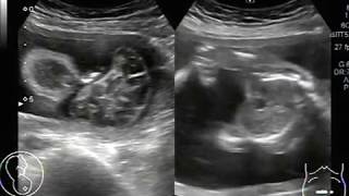 Ultrasound Video showing anencephaly with polyhydramnios [upl. by Trin]