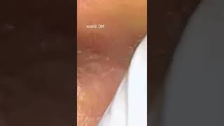 Pickel Ausdrücken Spa  Blackheads Akne amp Mitesser entfernen 🔴 33 [upl. by Ised]