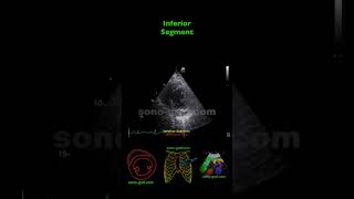 Echocardiography  Inferolateral And Inferior Hypokinesia [upl. by Munshi416]