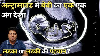 ultrasound se jane ladka ya ladki  sonography se kaise jane ladka hai ya ladki  level 2 ultrasound [upl. by Aronoh]