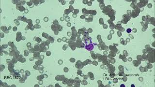 leishmania amastigotesSkin ulcer Giemsa Stain [upl. by Kirt645]