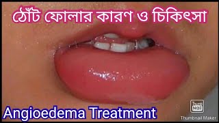 ঠোঁট ফোলার কারণ  ঠোঁট ফোলা কমানোর উপায়  Angioedema Treatment [upl. by Eet905]