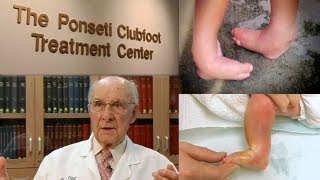 A Walking Miracle  The Ponseti Method for Clubfoot Treatment [upl. by Nelo415]