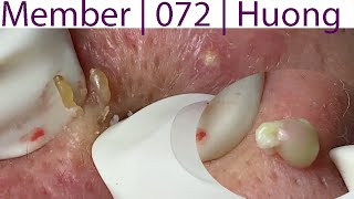 Acne Treatment Huong Da Nang 072  Member [upl. by Ralli188]