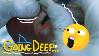 Deeply Satisfying Corn and Callus removal GOING JAWS DEEP [upl. by Rorry]