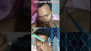 low cost Hair Transplant kolkata [upl. by Ysnil]