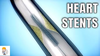 Drugeluting stents DES Vs Bare metal stents BMS [upl. by Ellenrahc309]