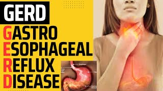 GASTROESOPHAGEAL REFLUX DISEASE  GERD  HEARTBURN  ACID REFLUX  ESOPHAGEAL REFLUX DISEASE [upl. by Gustafson]