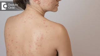 Tips to deal with Back Acne  Dr Swetha Sunny Paul [upl. by Vitia]