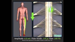 Spinal Cord Stimulation Overview [upl. by Fauman681]