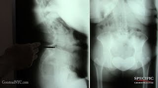 Double Spondylolisthesis without surgery by Dr Suh Gonstead Chiropractic [upl. by Ariik997]