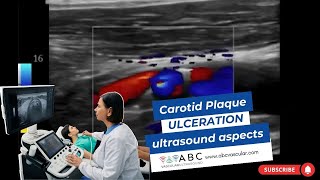 CAROTID PLAQUE ULCERATION ULTRASOUND ASPECTS [upl. by Bussey]