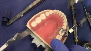 Restoration in Amalgam  30 MO [upl. by Anytsirk]