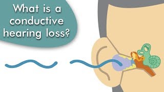 Conductive Hearing Loss Explained [upl. by Furey]