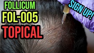 FOLLICUM FOL005 TOPICAL HUMAN TRIAL UPDATE [upl. by Chace213]