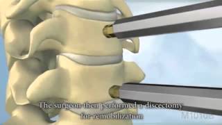 cervical artificial disc cervical artificial disc surgery  ProDisc neurosurgeon hk [upl. by Milli]