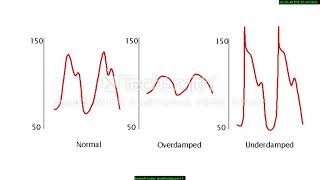 Hemodynamic monitoring part 1 Arterial line  Dr Jayram Navade  Dr Anuja Dharmale [upl. by Eiramesor143]