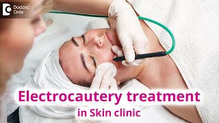 Use of Electrocautery Treatment in Skin Clinic  Electrocautery  Dr Rasya Dixit  Doctors Circle [upl. by Kraft]