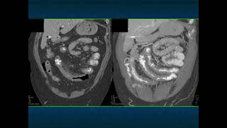 Abdominal Pain in the ER GI Pathology  Part 1 [upl. by Elohcim202]