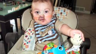 Cleft Lip and Palate  Nicholas Amazing Journey [upl. by Dnalkrik658]