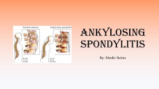 Ankylosing spondylitis  signs and symptoms Schober test Faber test imaging treatment [upl. by Paz62]