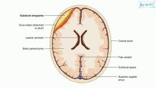 subdural empyema [upl. by Flossi411]