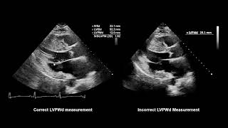 How to Measure Wall Thickness with Echocardiography [upl. by Airdnoed]