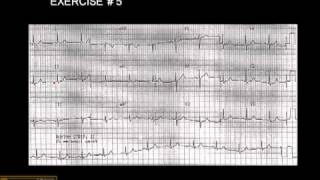 1215 Lead ECG Exercise  5 [upl. by Ashbey]