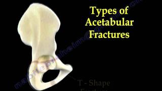 Acetabular Fractures  Everything You Need To Know  Dr Nabil Ebraheim [upl. by Arten]