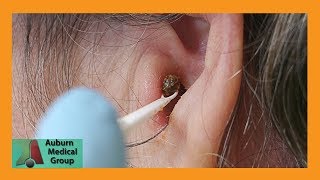 Chunky Earwax Removal  Auburn Medical Group [upl. by Kind936]