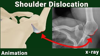 West point and Stryker notch views for anterior shoulder dislocations animated [upl. by Hoj]