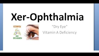 Ophthalmology 475 Xerophthalmia Vitamin A deficiency Eye Night blindness Ocular Classify Pediatrics [upl. by Bain]