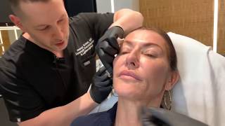 Sculptra  CollagenStimulating Injections  West Hollywood CA  Dr Jason Emer [upl. by Ecerehs]