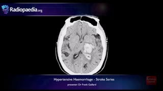 Stroke Hypertensive haemorrhage  radiology video tutorial MRI CT [upl. by Franklin]