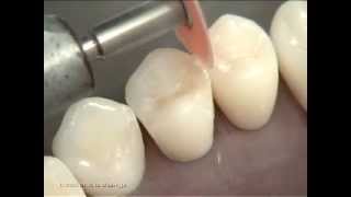 Composite Class II Preparation and Restoration on Premolar [upl. by Neelia]