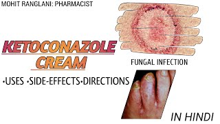 Ketoconazole cream  UsesSide effectsDose and precautions  In Hindi [upl. by Dareg596]