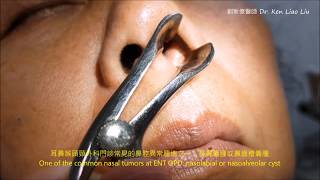 鼻翼囊腫 鼻齒槽囊腫 nasoalveolar cyst nasolabial cyst [upl. by Nnaeirual]