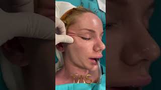 Scarless facelift amp neck lift by the one and only Dr Suleyman Tas [upl. by Mashe]