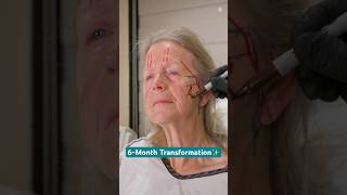 Amea’s 6Month Preservation Facelift Results✨ [upl. by Enelam]