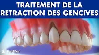 Récession Gingivale – Traitement de la retraction des gencives © [upl. by Rhine483]