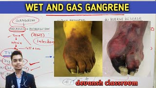 general Pathology  wet and gas gangrene  Hindi [upl. by Eadmund]